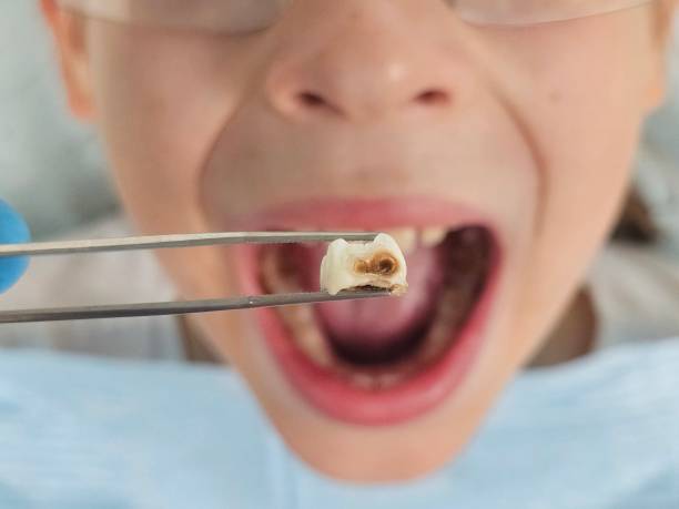 Best Emergency Tooth Extraction in Hornsby Bend, TX